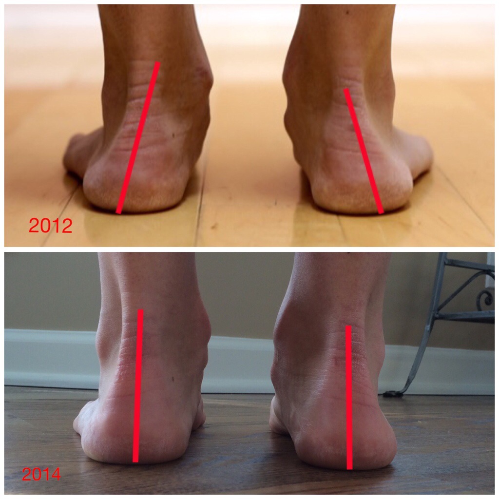 Barefoot walking builds foot strength while preventing pain and injuries –  United Podiatry Inc