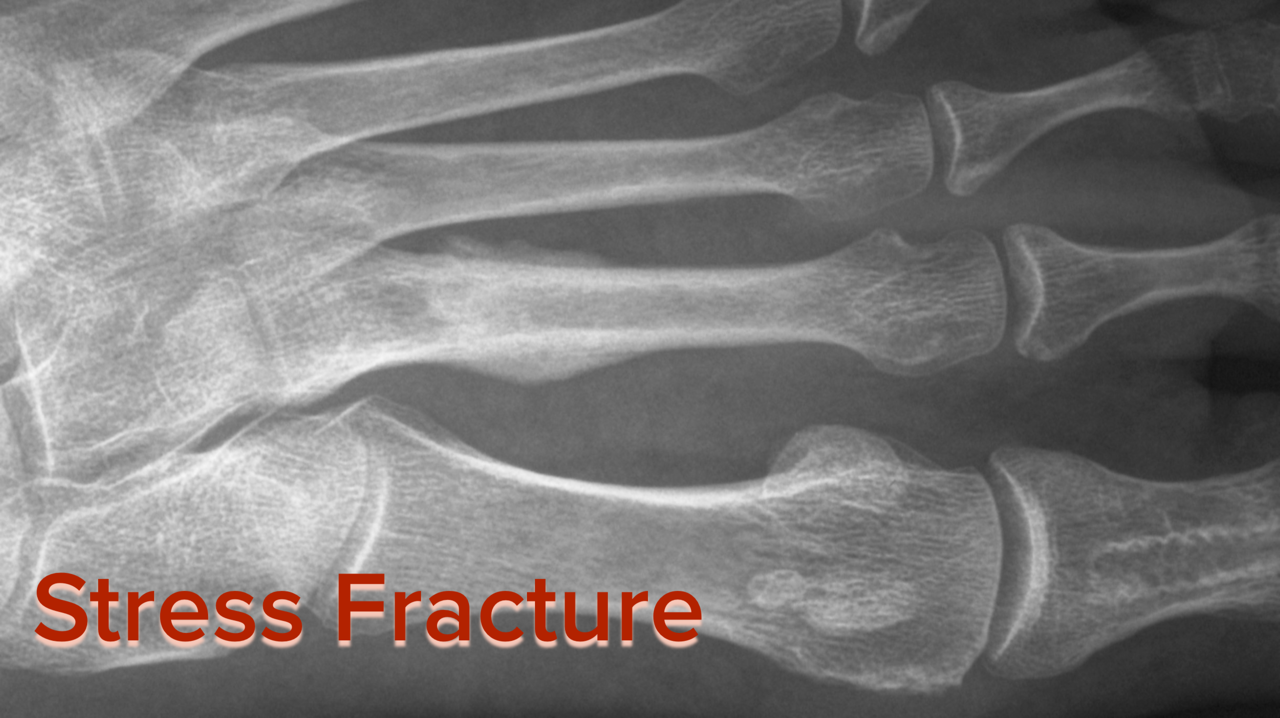 stress fracture in foot