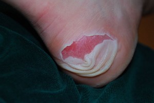 heel-blister-300x201
