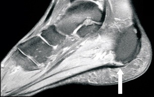 Plantar Fascitis commonly misdiagnosed as a calcaneal or heel stress fracture.